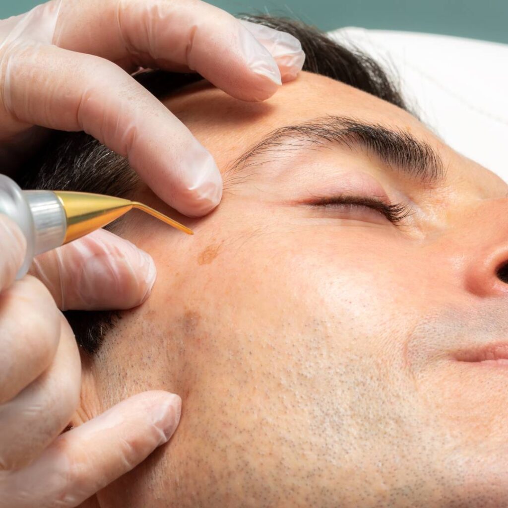 Man receiving plasma pen treatment