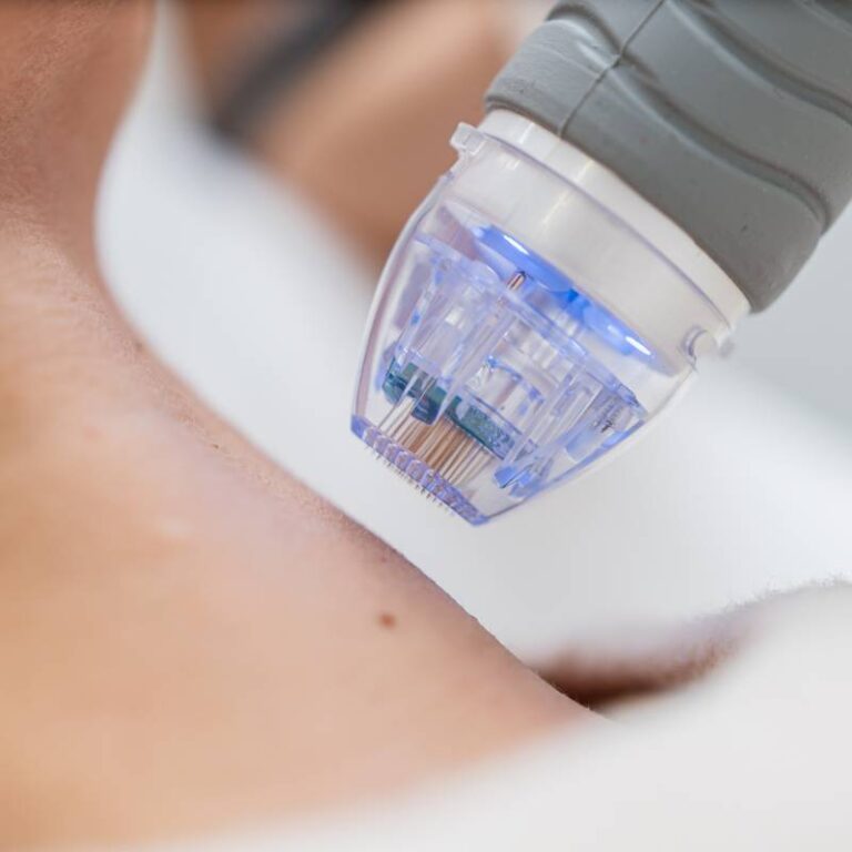 Microneedling machine working to tighten loose skin