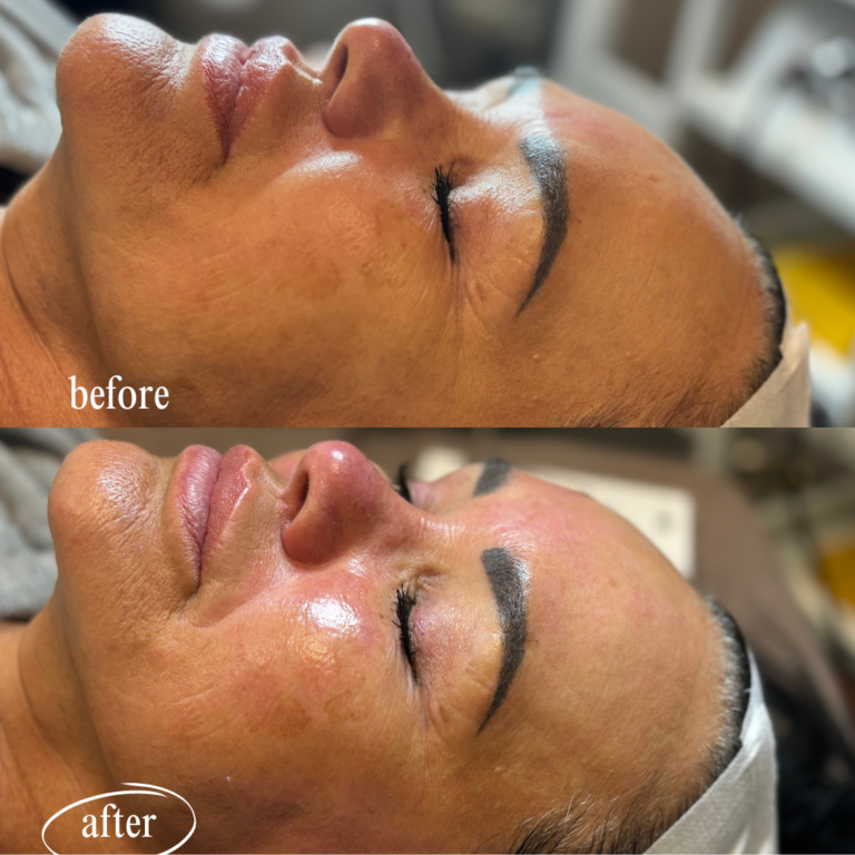 Medical Grade Peel